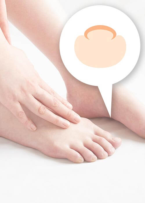 巻き爪、陥入爪など爪の治療に注力しています