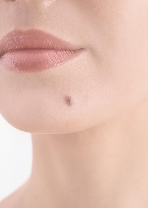 ほくろやいぼ切除などの日帰り手術にも対応可能です